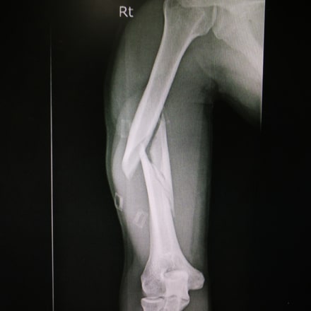 Supracondylar Humerus Fracture resulting in Malunion